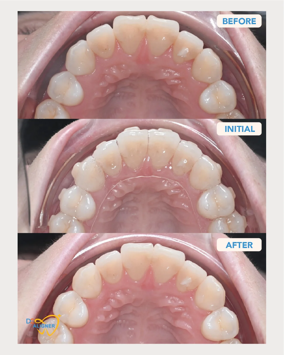 รีวิวจัดฟันใส DC Aligner 2 มุมขากรรไกรบน