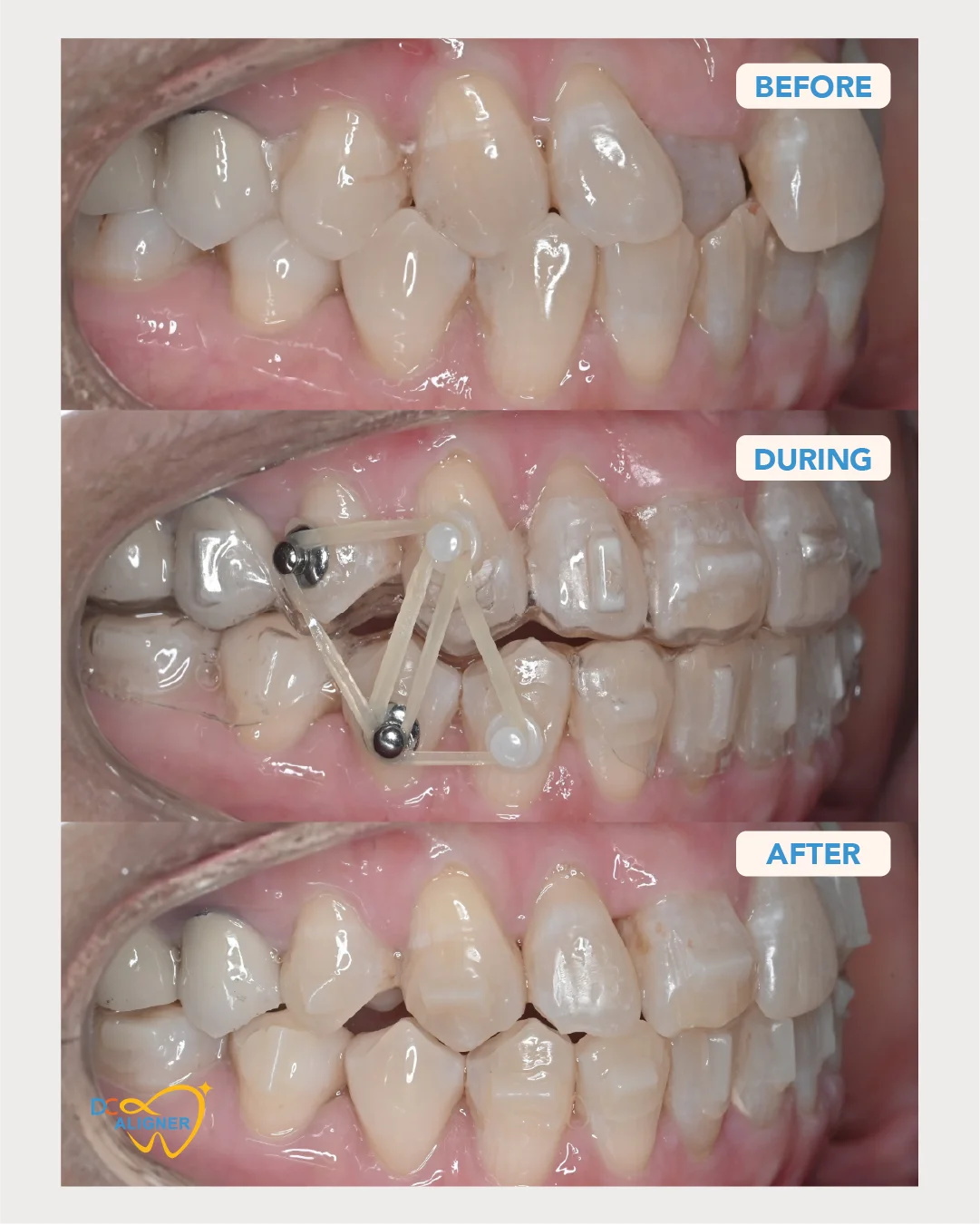 รีวิวจัดฟันใส DC Aligner 3 มุมด้านขวา